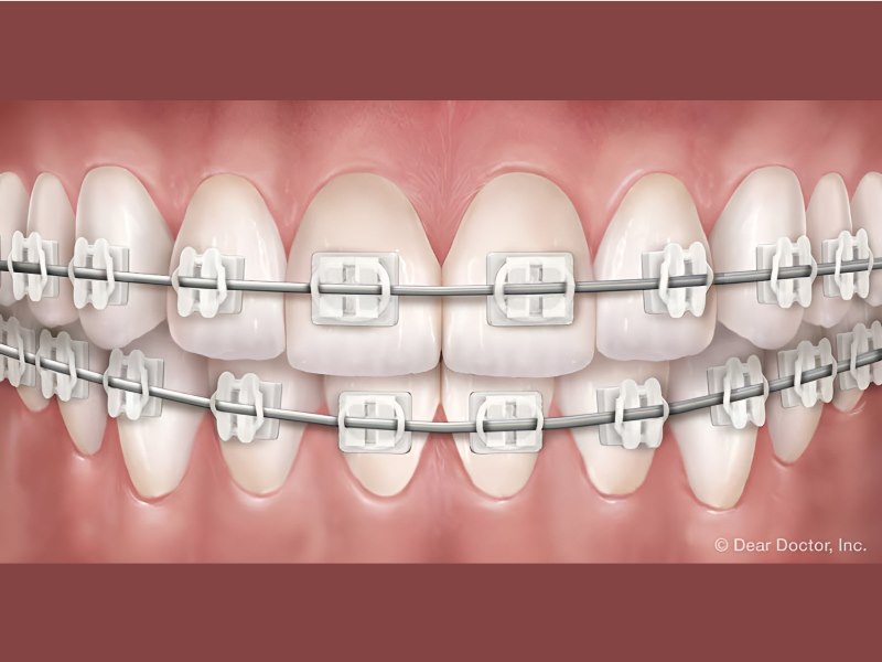 Orthodontic Treatments for Adults | Canepa Orthodontics