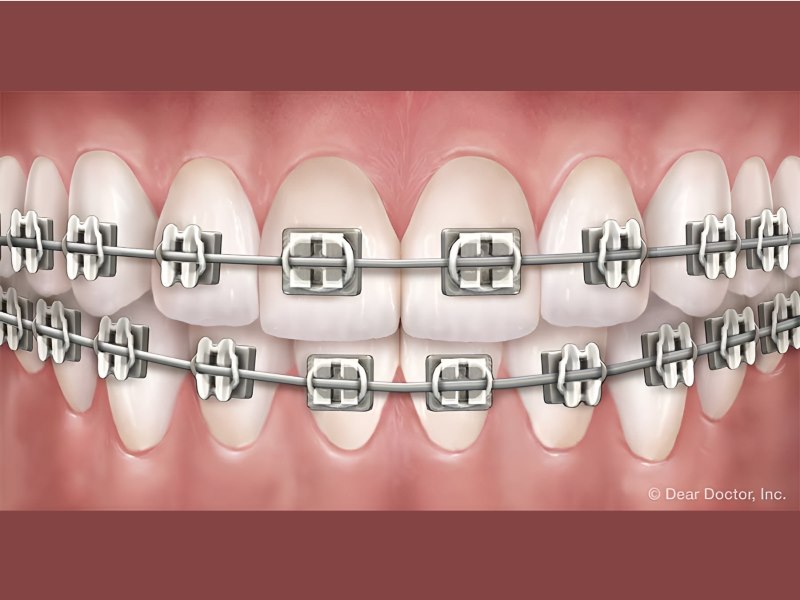 Orthodontic Treatments for Adults | Canepa Orthodontics